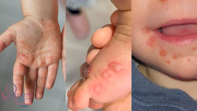 Hand, Foot and Mouth Disease: What Parents and Educators Need to Know